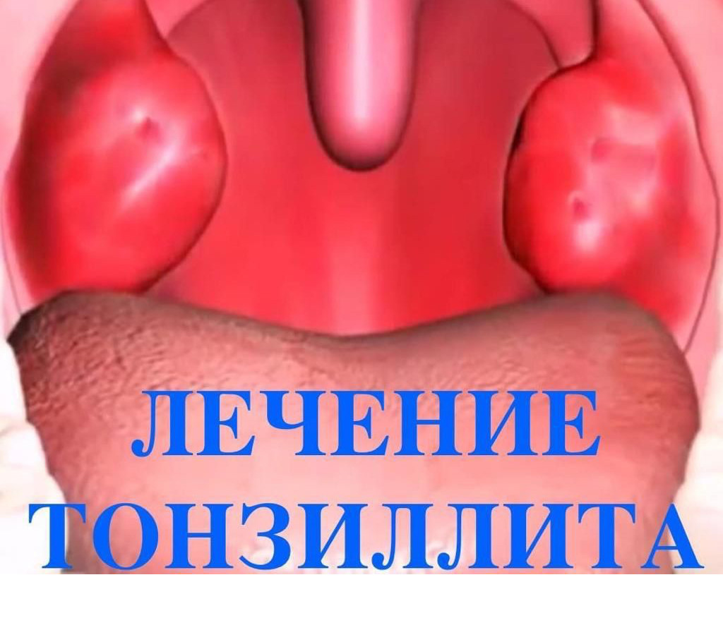 Хронический тонзиллит Хронический тонзиллит